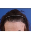 After Hair Transplant&nbsp;Hairline
